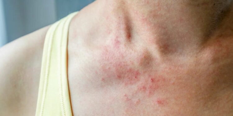 Dust Allergy Troubles? Simple Home Changes That Can Help You Breathe Easy